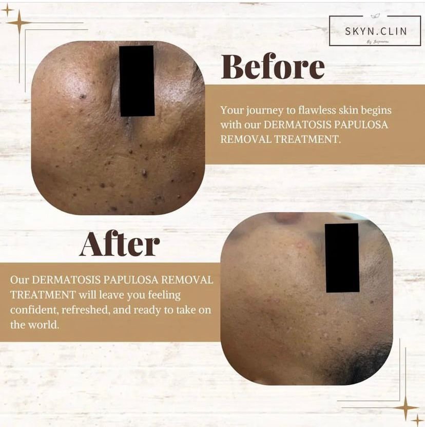 Skin Blemish Removal