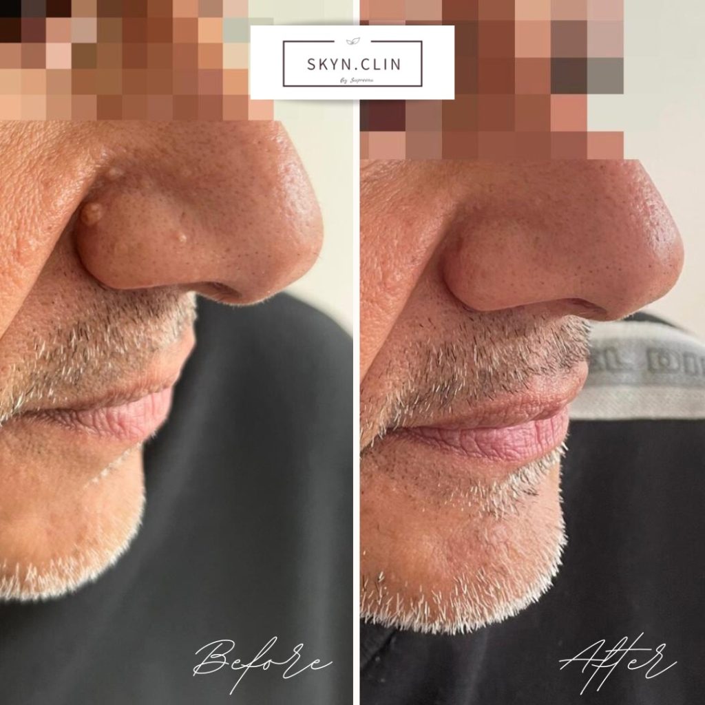 Before and after skin blemish removal treatment at SKYN.CLIN Staines