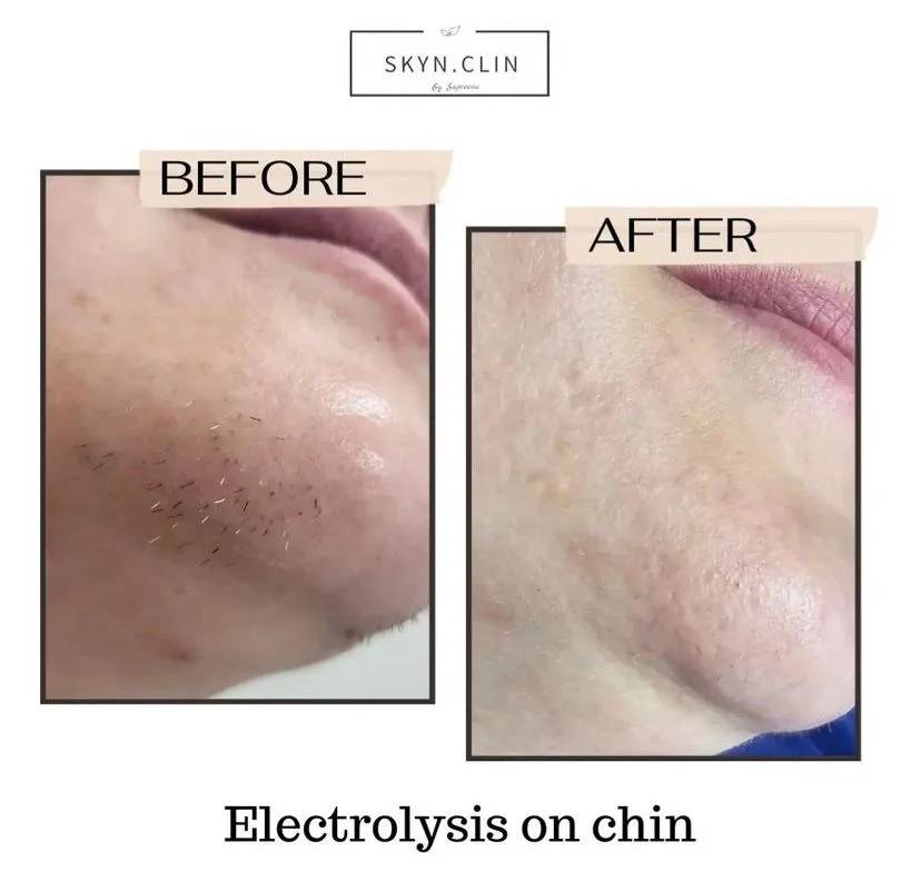 Before and after electrolysis hair removal on chin at SKYN.CLIN Staines showing smooth, hair-free skin