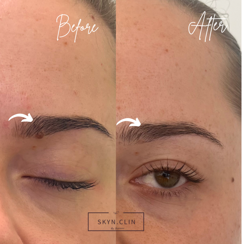 Before and after skin blemish removal near eyebrow at SKYN.CLIN Staines