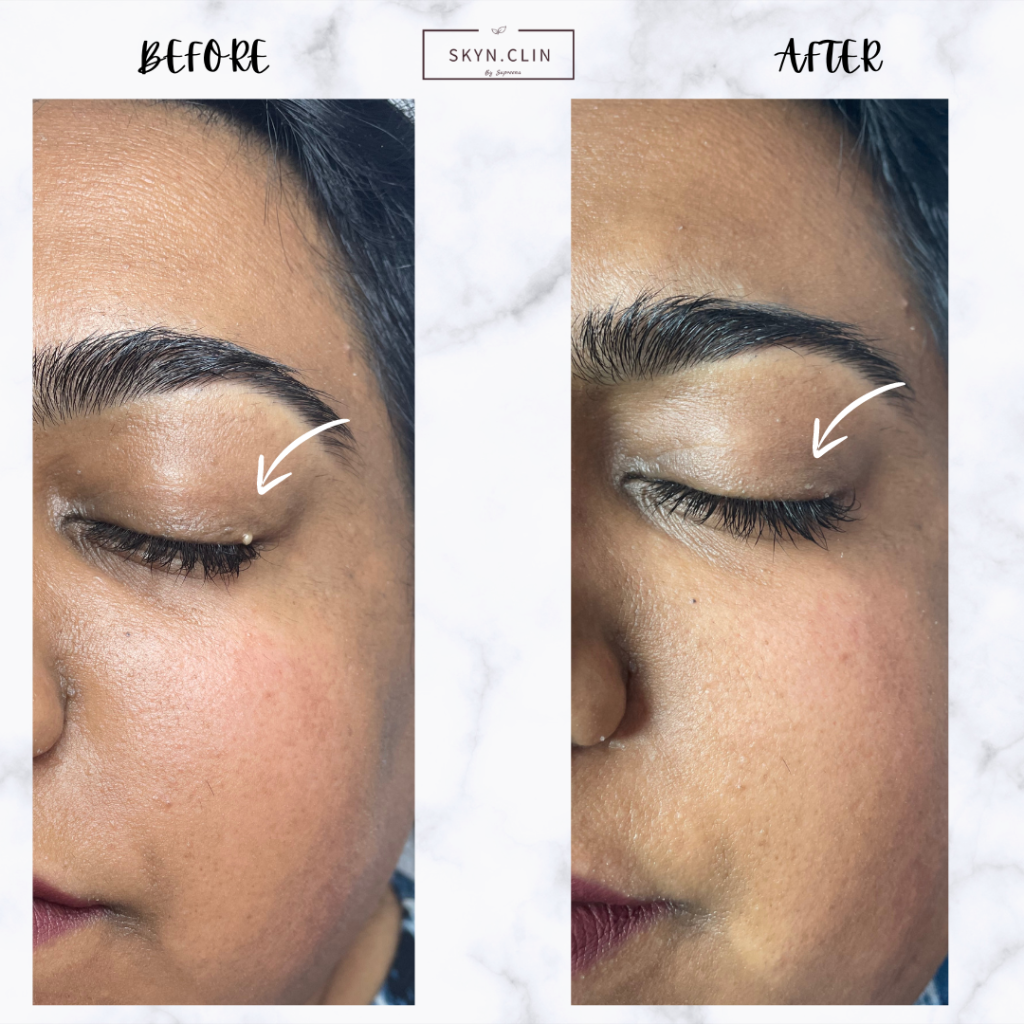 Before and after skin tag removal near the eye at SKYN.CLIN Staines showing smooth and clear skin