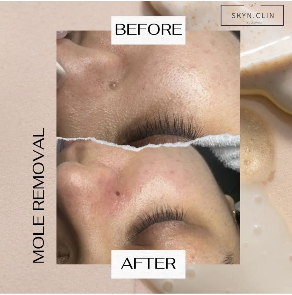 Before and after mole removal treatment at SKYN.CLIN Staines showing clearer skin with minimal redness