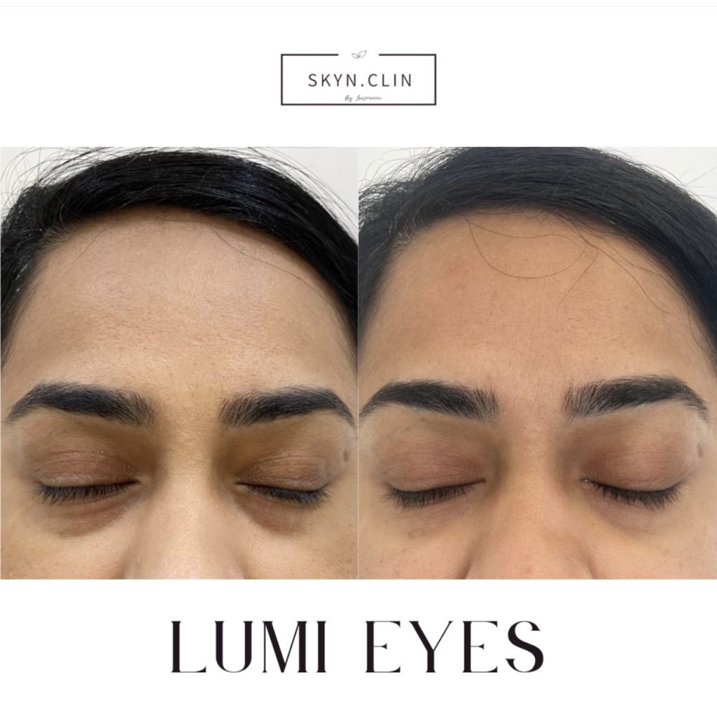 Before and after under eye filler treatment at SKYN.CLIN Staines showing reduced hollowness and refreshed appearance