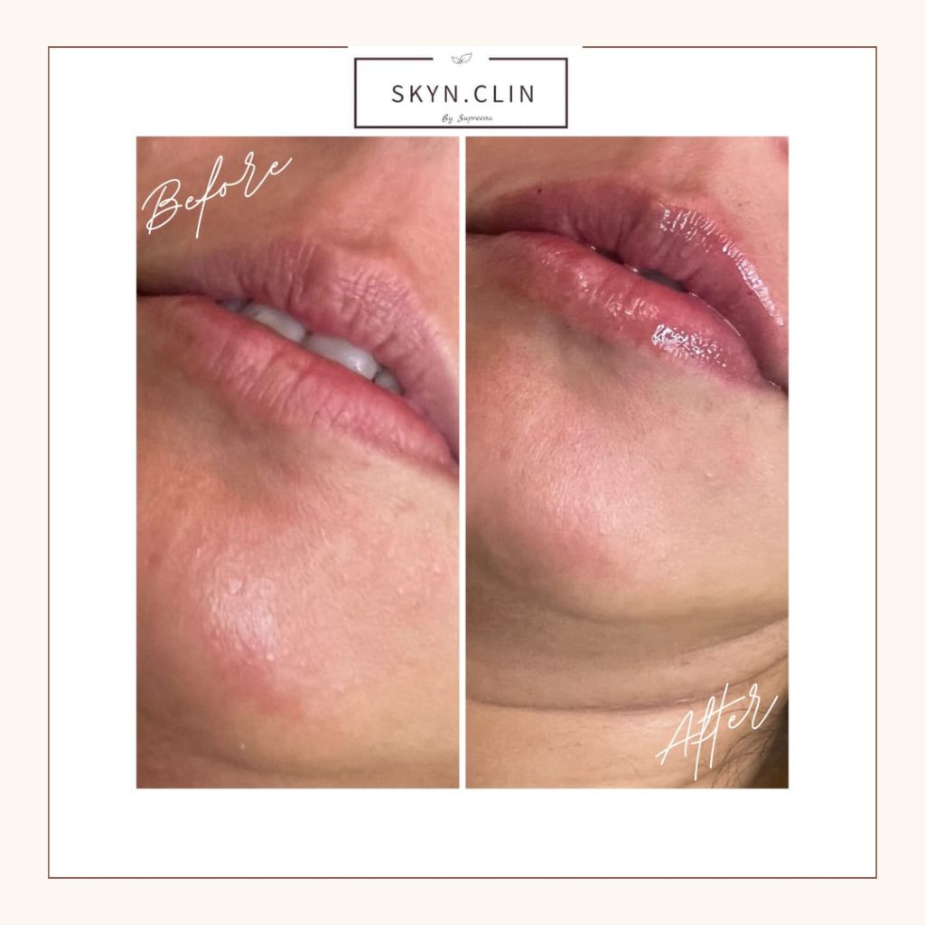 Before and after lip filler treatment at SKYN.CLIN Staines showing enhanced volume and definition