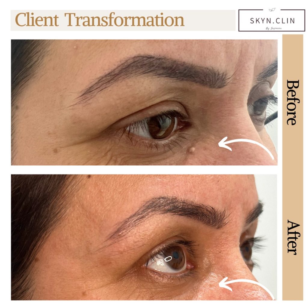 Before and after skin tag removal near the eye at SKYN.CLIN Staines showing smoother, clearer skin