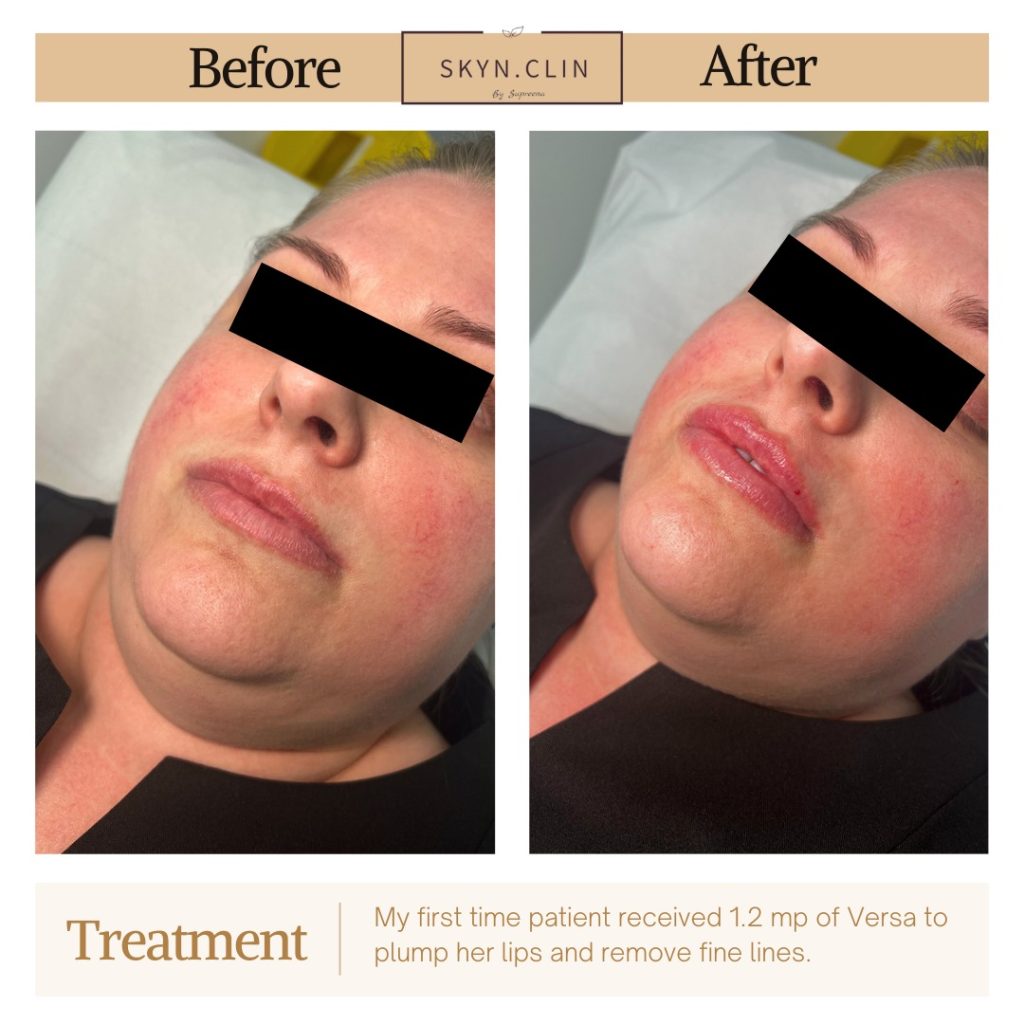 Before and after lip filler treatment with 1.2 ml of Versa at SKYN.CLIN Staines showing enhanced lip volume and reduced fine lines