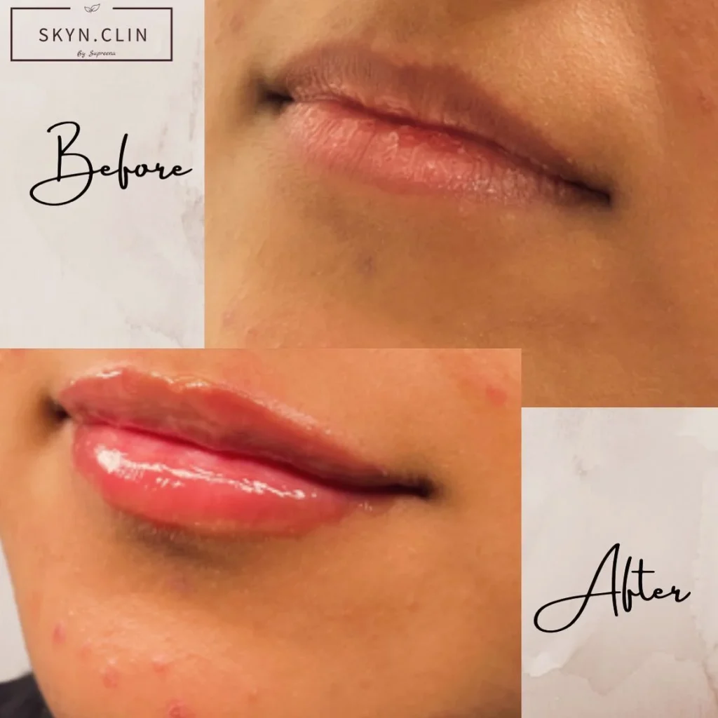 Before and after lip filler treatment at SKYN.CLIN Staines for fuller, smoother lips